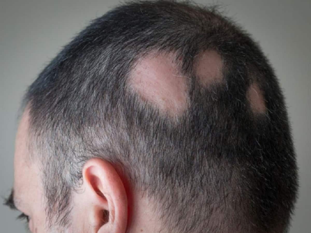 Are Dietary Supplements Helpful In Premature Baldness? Dietician Explains